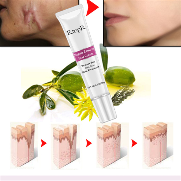 Skin Healing Acne Scar Cream