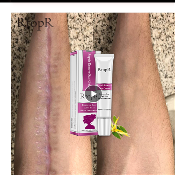 Skin Healing Acne Scar Cream