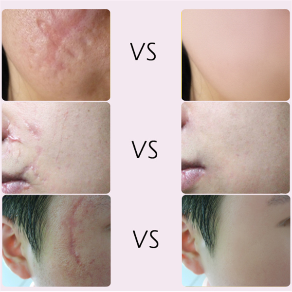 Skin Healing Acne Scar Cream